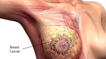 10-things-about-breast-cancer-s2-what-is-breast-cancer